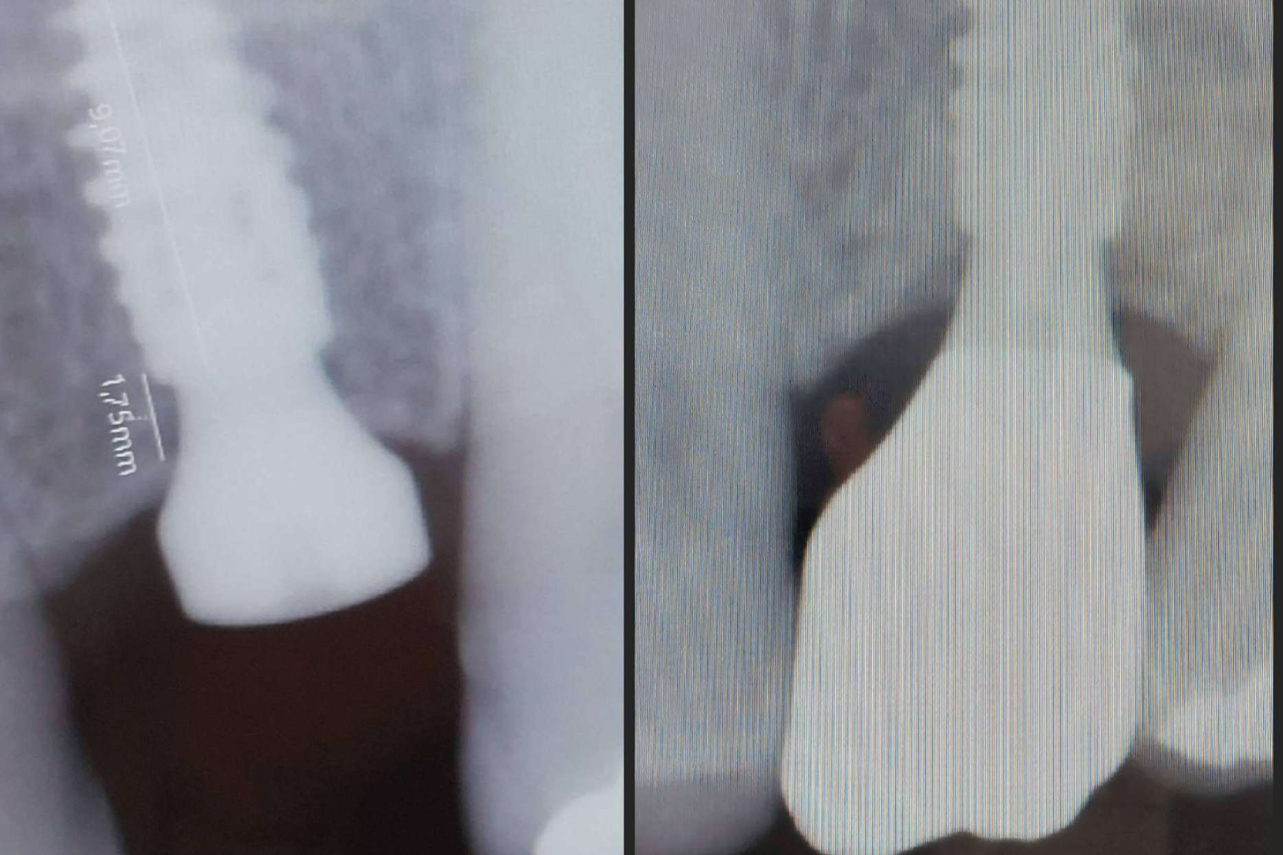Llevar a cabo implantes dentales en un día es posible gracias a la tecnología digital de Dentinova