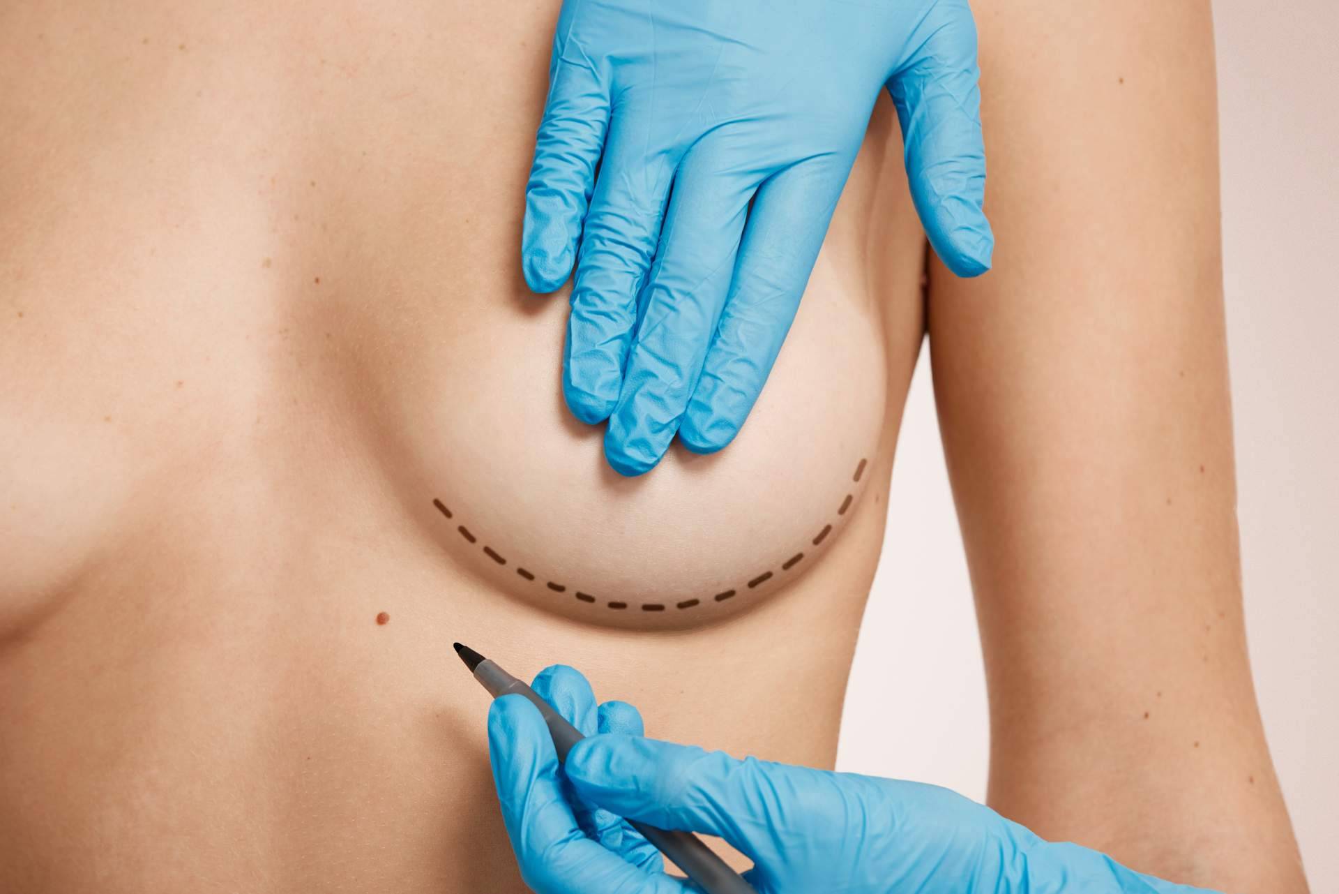 Beauty&Beauty aborda la reducción de pecho desde la personalización y la innovación médica