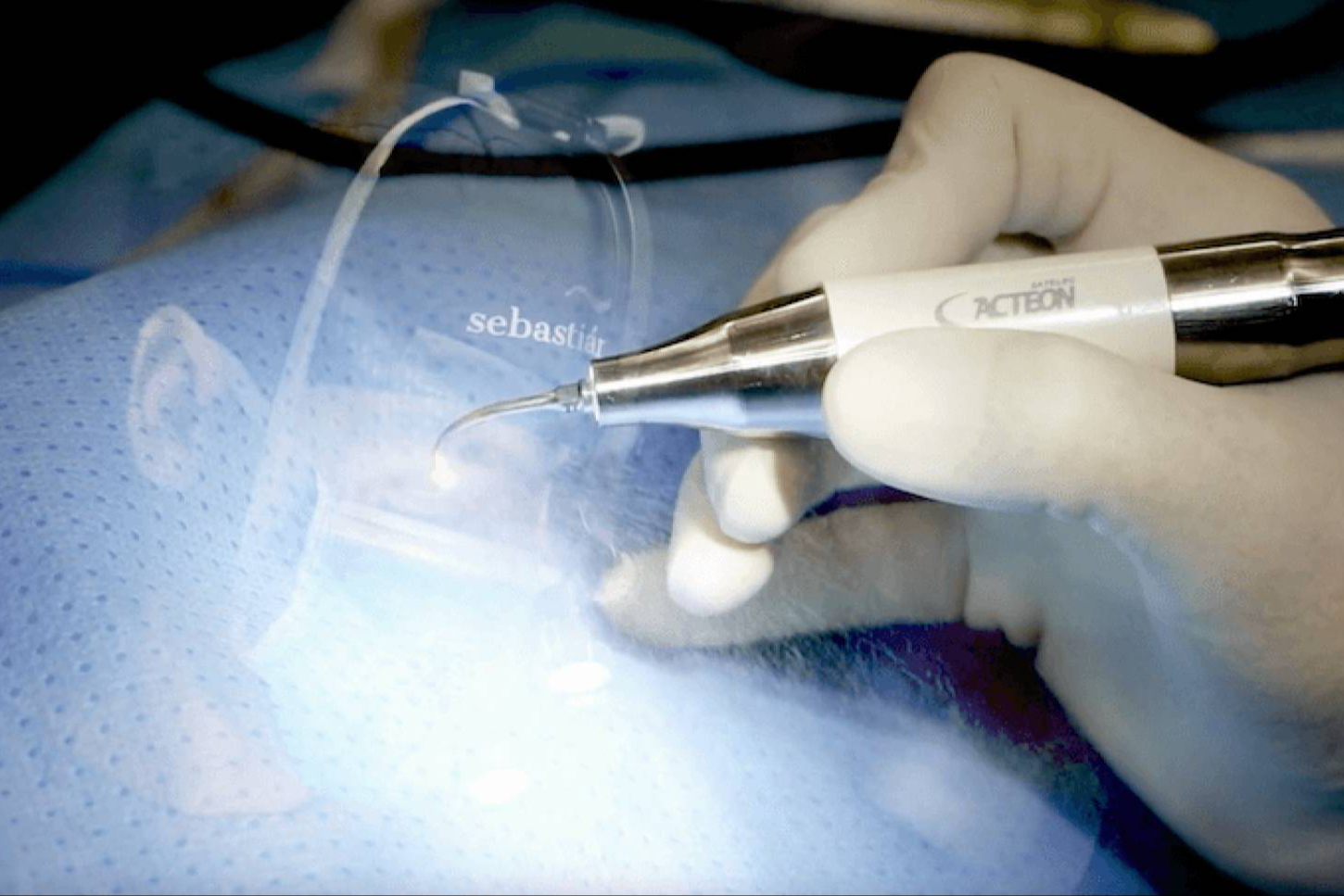 La rinoplastia ya no es solo estética; la tecnología ultrasónica impulsa una nueva era en cirugía nasal