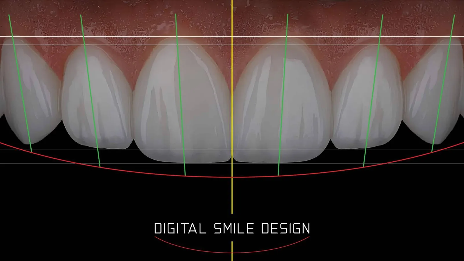La tecnología digital del Instituto Smile Design by Fernando Soria permite renovar la sonrisa en Madrid en una sola jornada